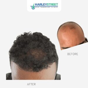 Calvin Before & Afters Calvin Before & Afters
