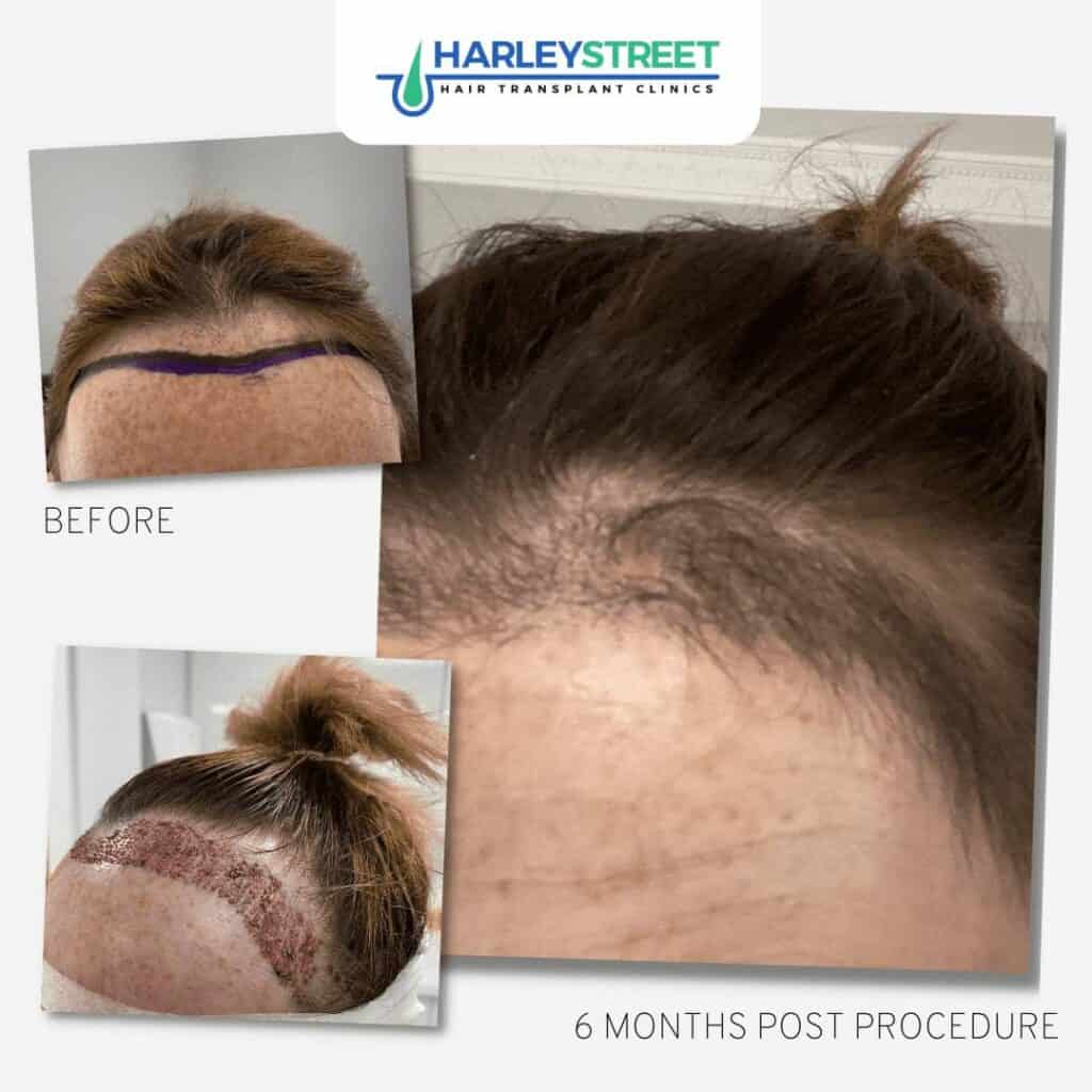 FUE-Female-Hair-Transplant-Before-and-After