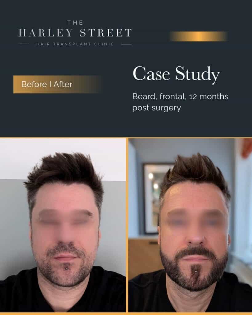 Harley-Street-HT-Patient-Beard-P-Burley-frontal