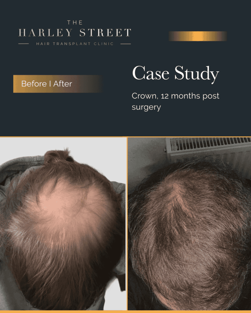 Harley-Street-HT-pt-Wagstaff-crown