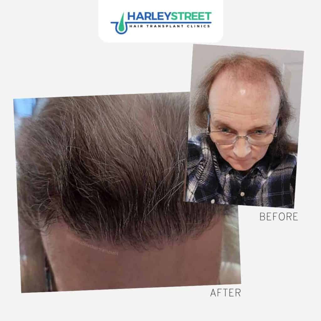 Harley-Street-Hair-Transplant-Clinics-patient-with-lots-of-hair-loss-before-and-after