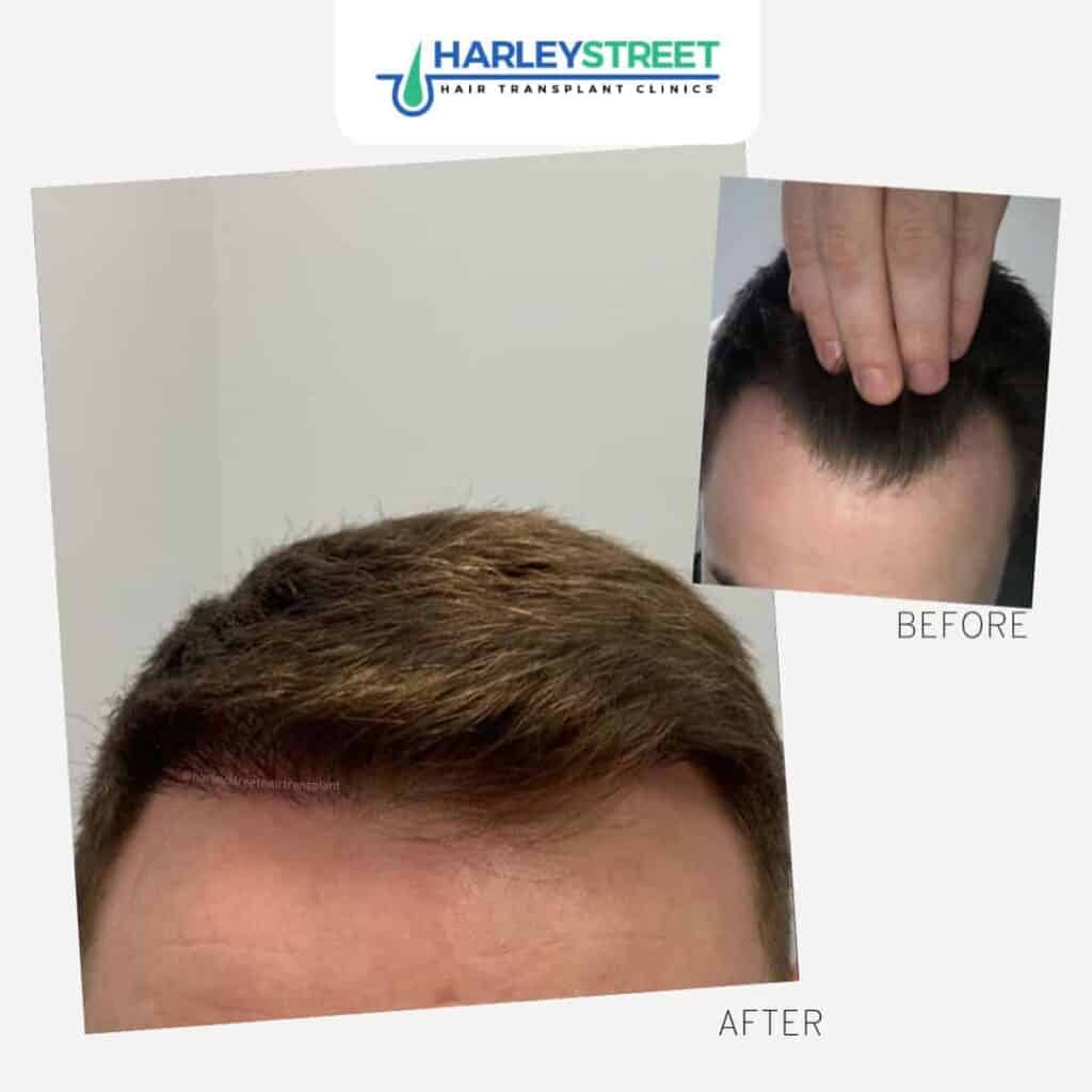 Harley-Street-Hair-Transplant-Clinics-patient-with-small-hairlines-recession-before-and-after